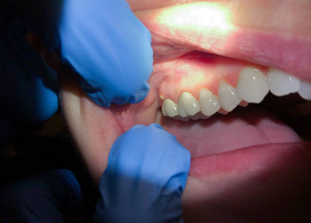 Best Emergency Wisdom Teeth Removal in Lacy Lakeview, TX